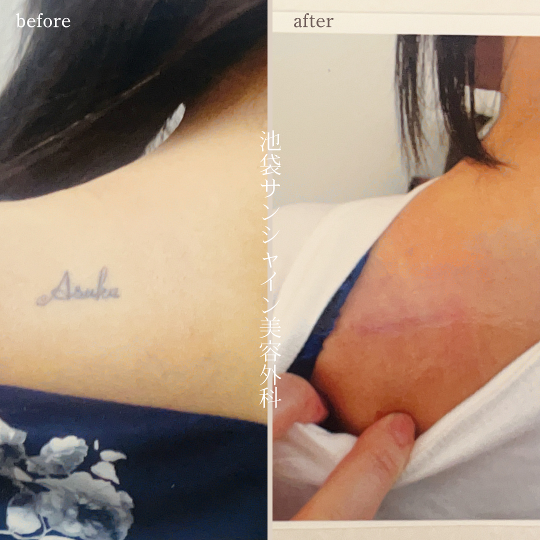 左背中英字name除去 before after　