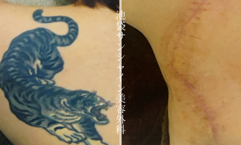 左背中虎除去 before after　