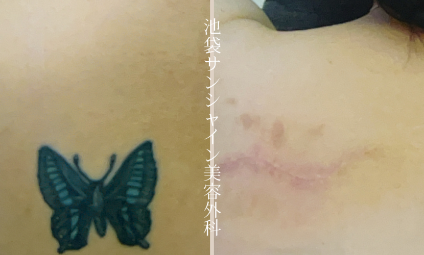 左背中蝶模様刺青除去 before after　