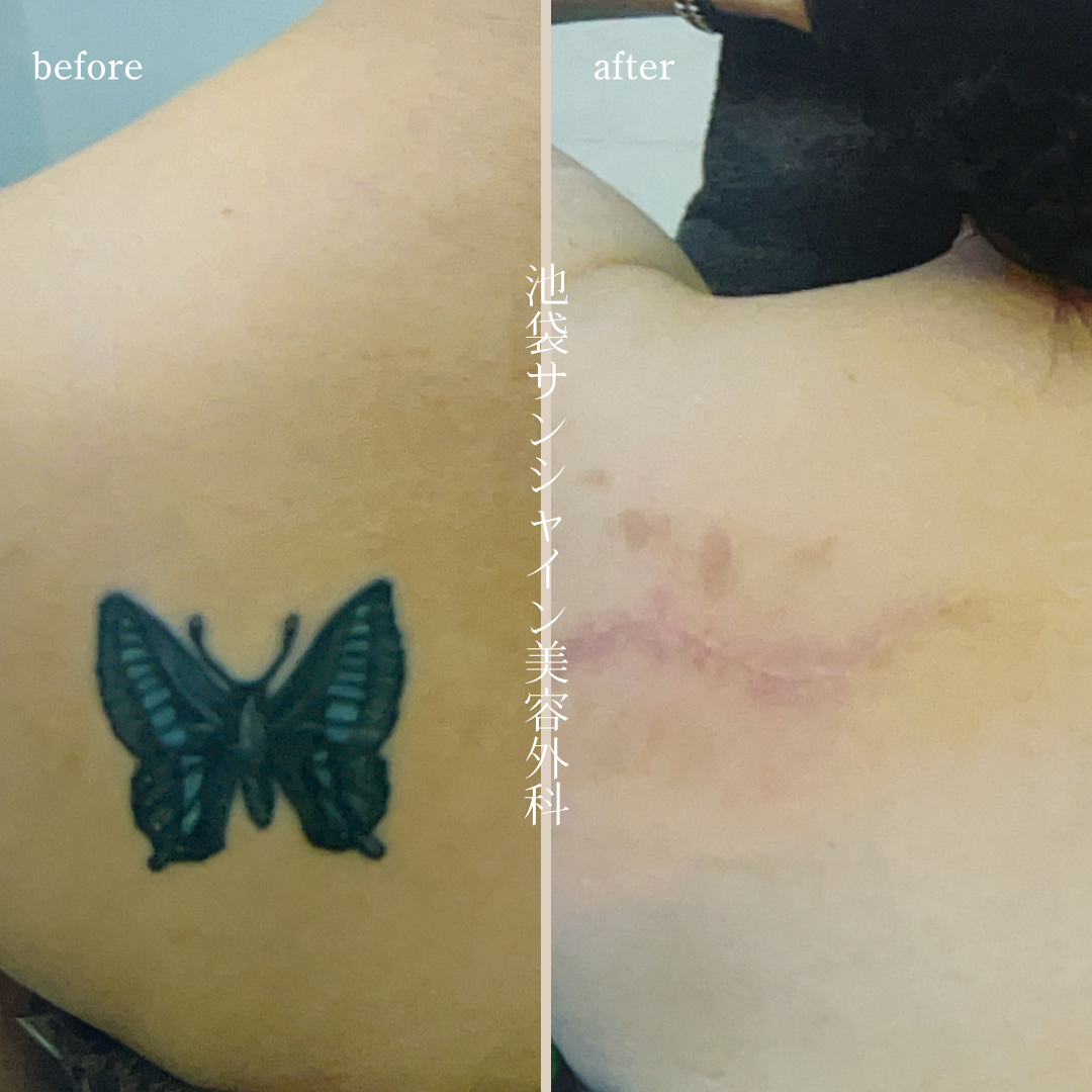 左背中蝶模様刺青除去 before after　