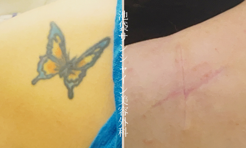 左背中蝶刺青除去 before after　