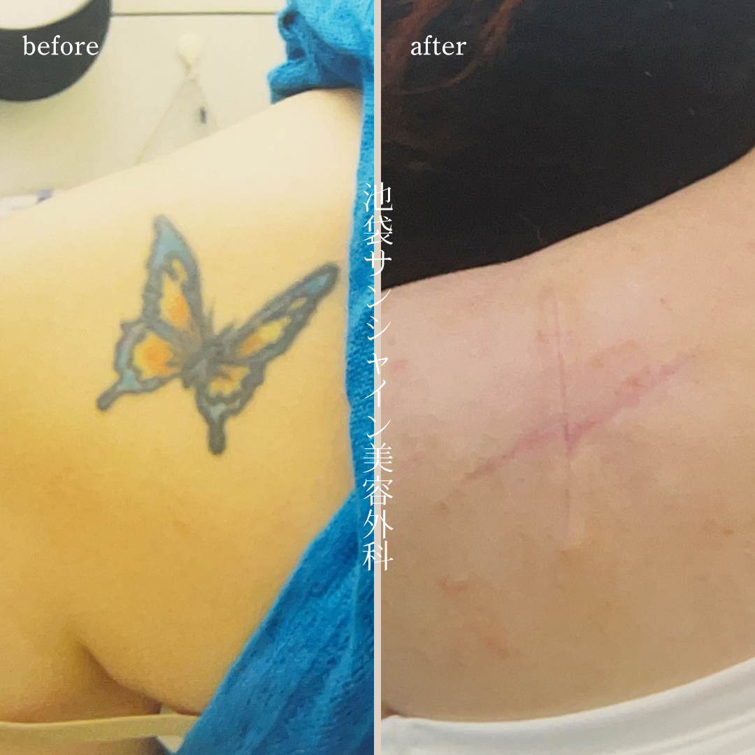 左背中蝶刺青除去 before after　