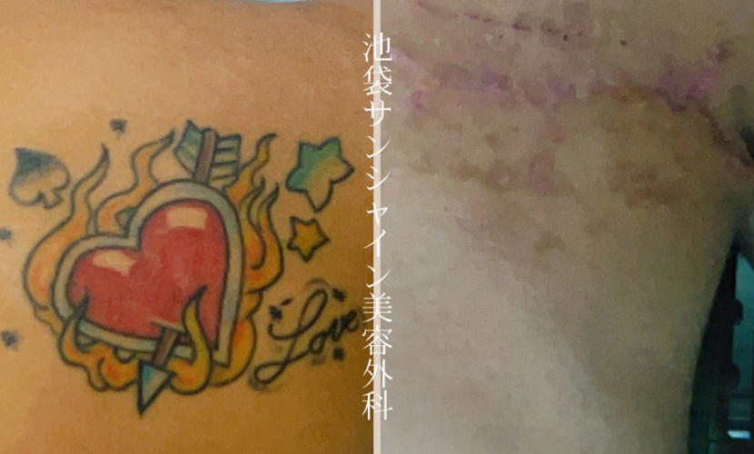 右背中赤ハート除去 before after　