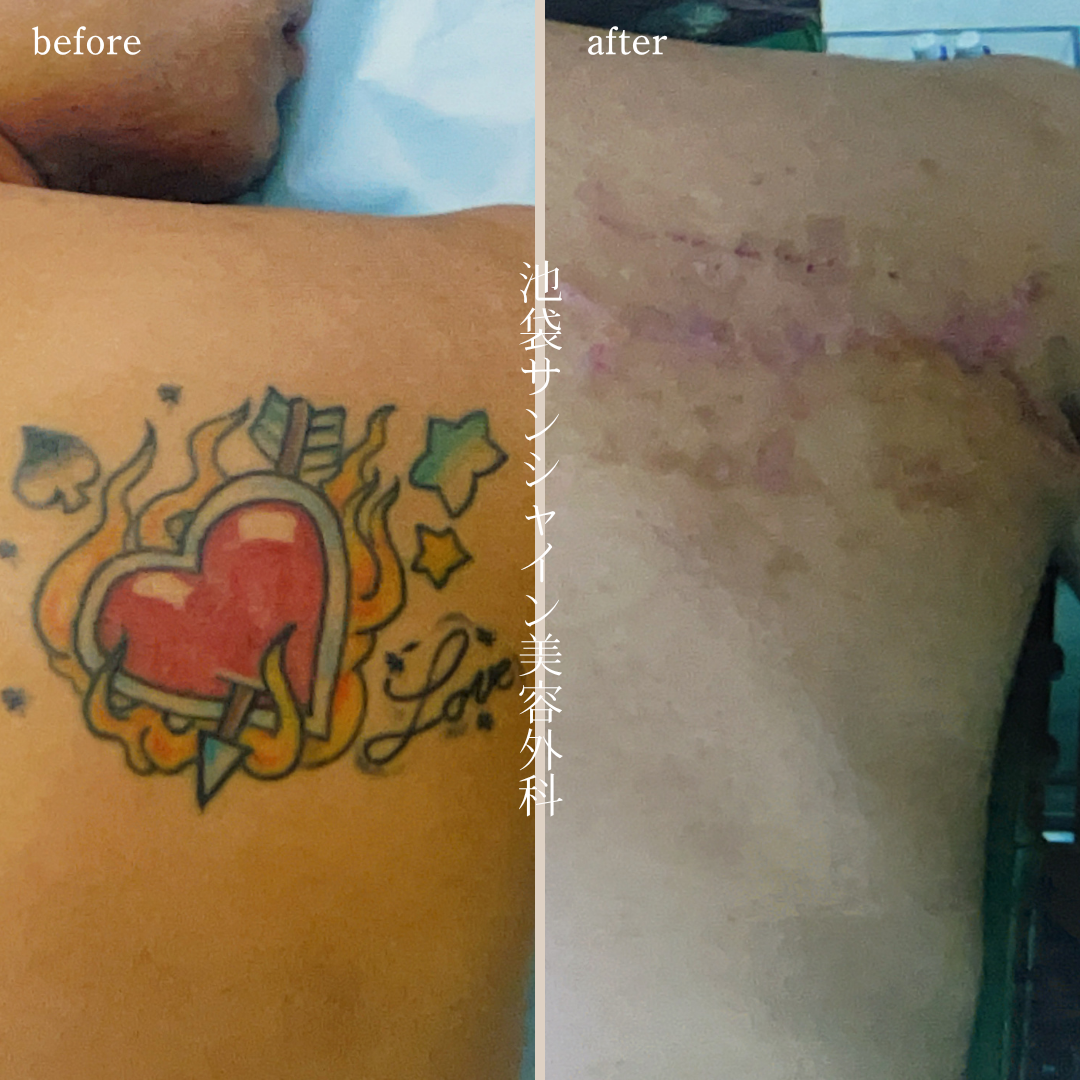 右背中赤ハート除去 before after　
