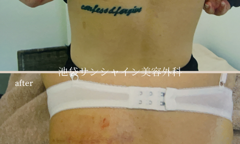 背中アルファベット模様タトゥ除去 before after　