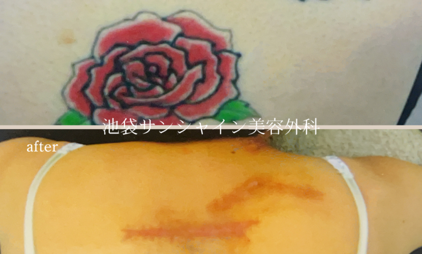 背中赤いバラと蝶刺青除去 before after　