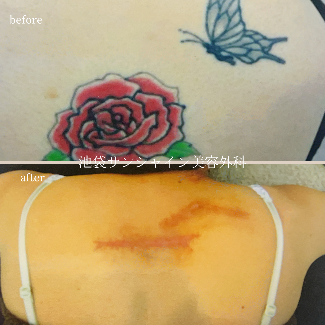 背中赤いバラと蝶刺青除去 before after　