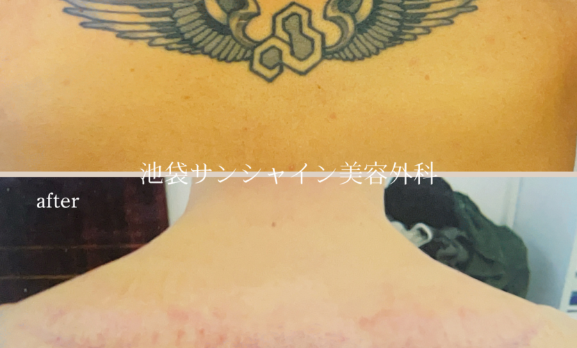 背中首下羽除去 before after　