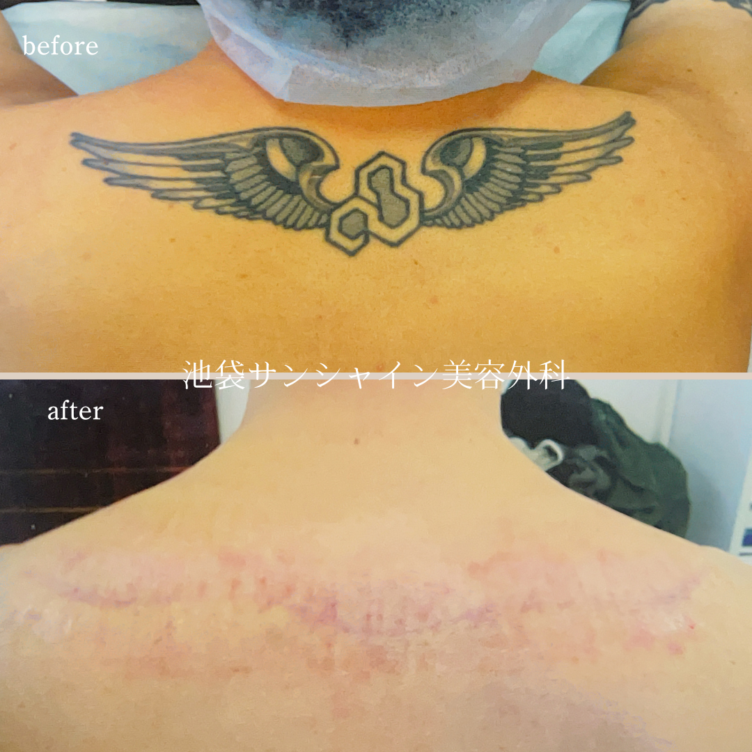 背中首下羽除去 before after　