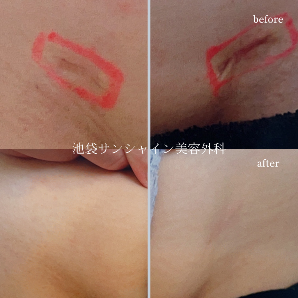 脂肪吸引傷跡 デリケートゾーン before after