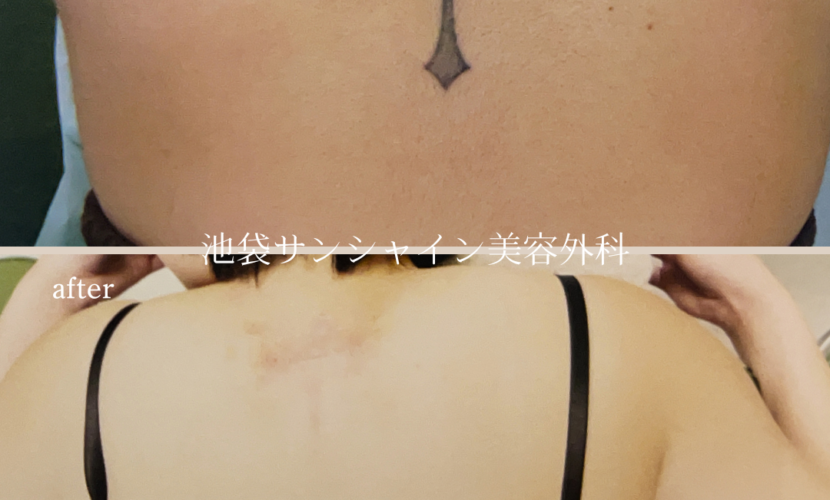 首下十字架蝶模様タトゥ除去 before after　
