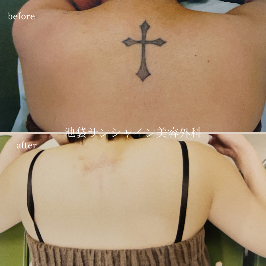 首下十字架蝶模様タトゥ除去 before after　