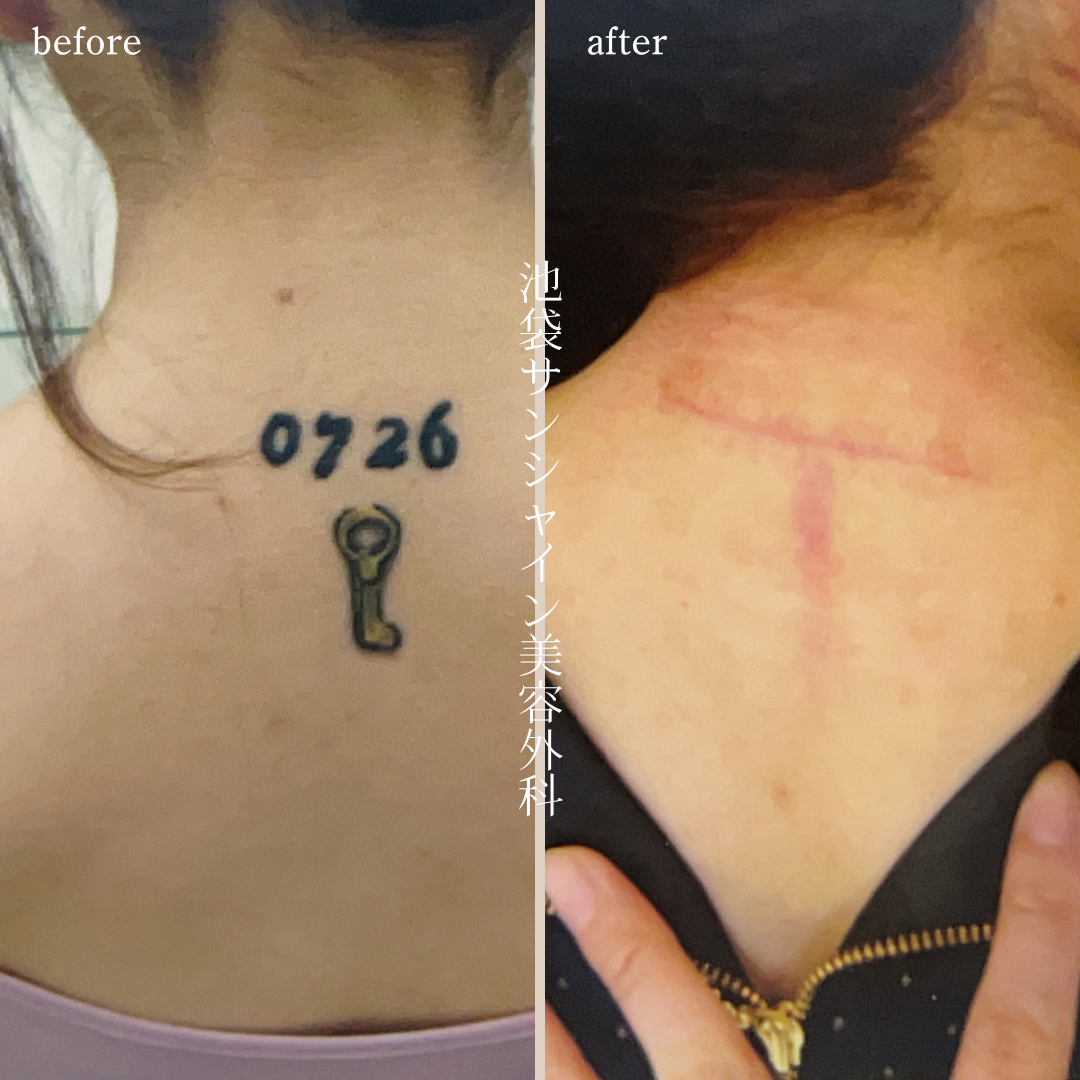 首下背中数字除去 before after　