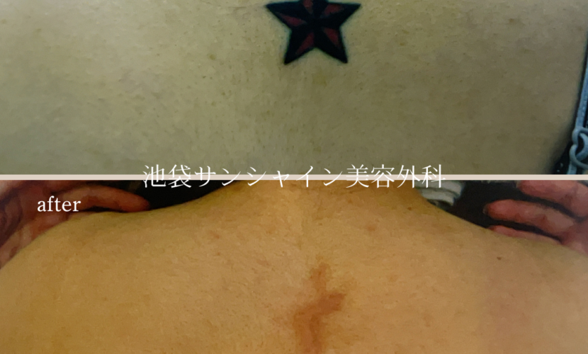 首下黒星模様タトゥ除去 before after