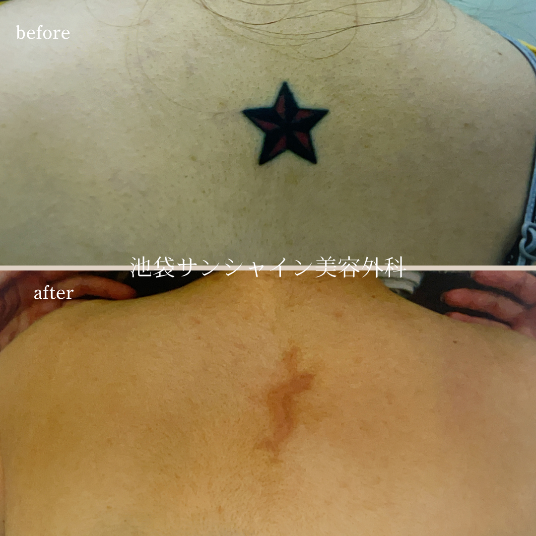 首下黒星模様タトゥ除去 before after