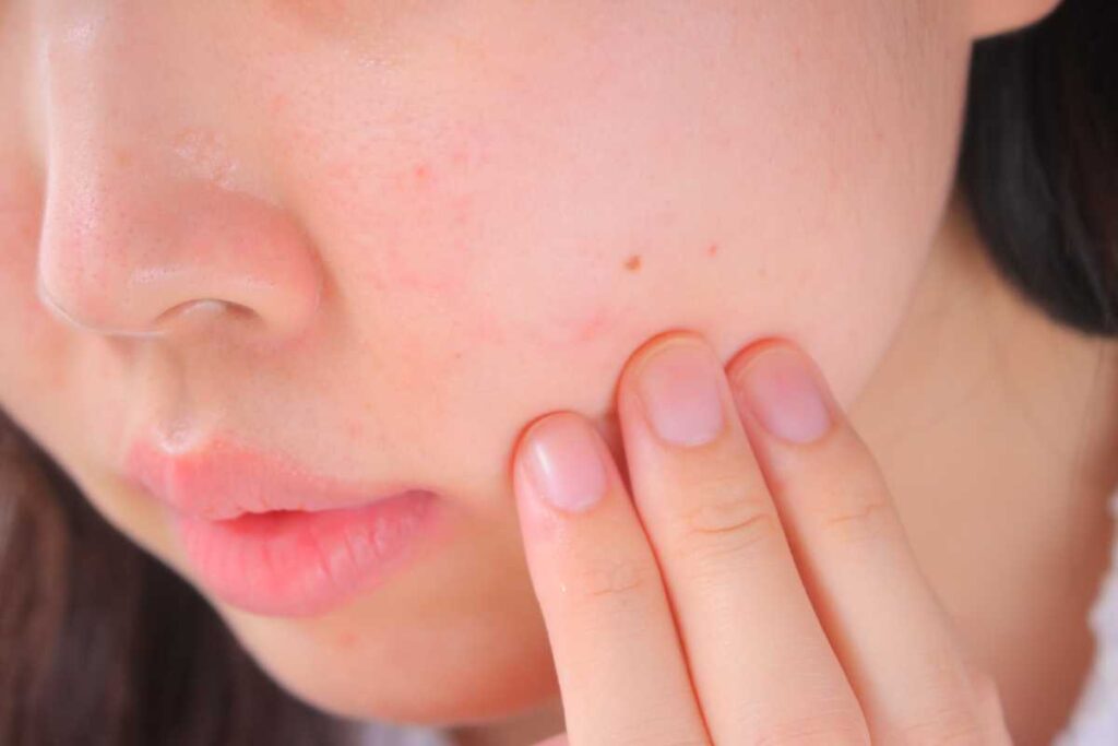 ほくろ除去の痕は消えない?1年経っても残る原因と対処法を徹底解説 2 ほくろ除去の痕が消えないのは一般的