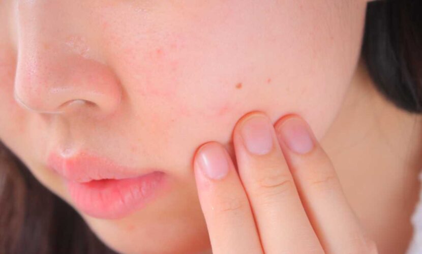 ほくろ除去の痕が消えないのは一般的