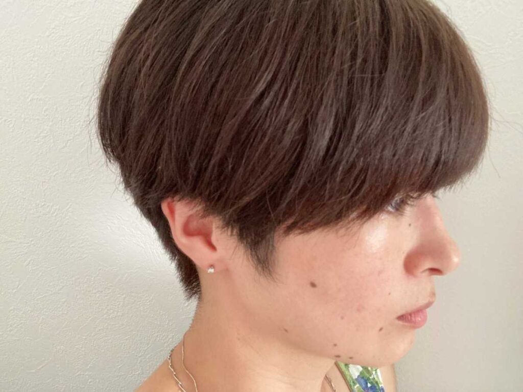 ほくろ除去の痕は消えない?1年経っても残る原因と対処法を徹底解説 4 ほくろ除去の痕が自然に治るケース、治らないケース