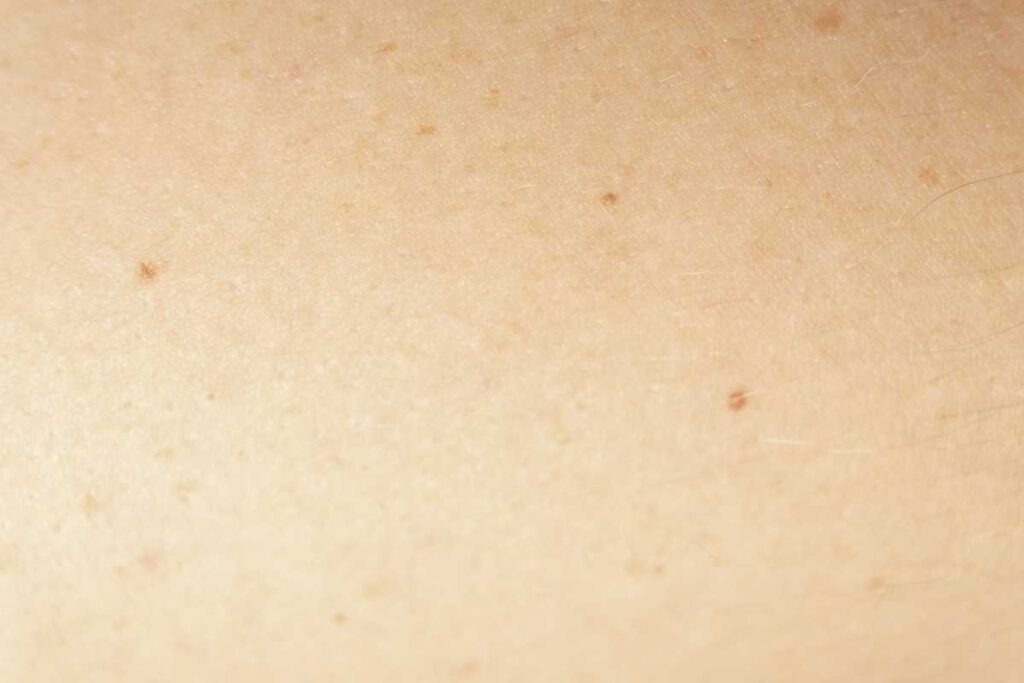 【医師が解説】ホクロが増えるのはなぜ?原因とほくろを消す治療法やケアを紹介 3 ホクロが増える原因・基礎知識