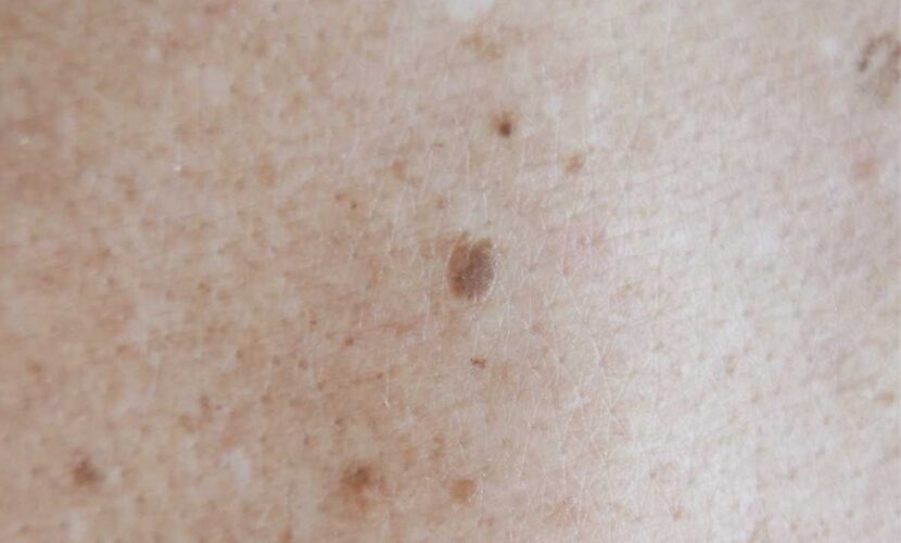preventing mole growth