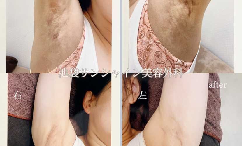 わき施術傷跡修正 左右 before after