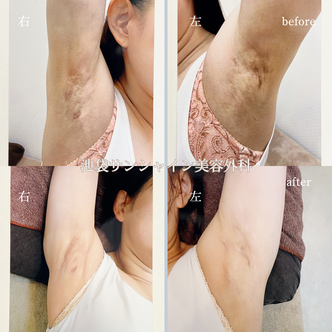 わき施術傷跡修正 左右 before after