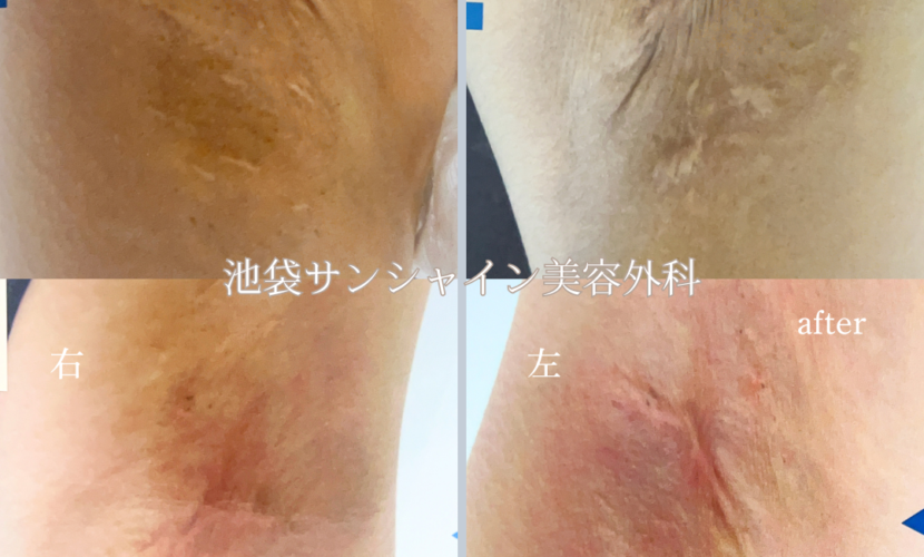 わき施術傷跡修正 左右 before after