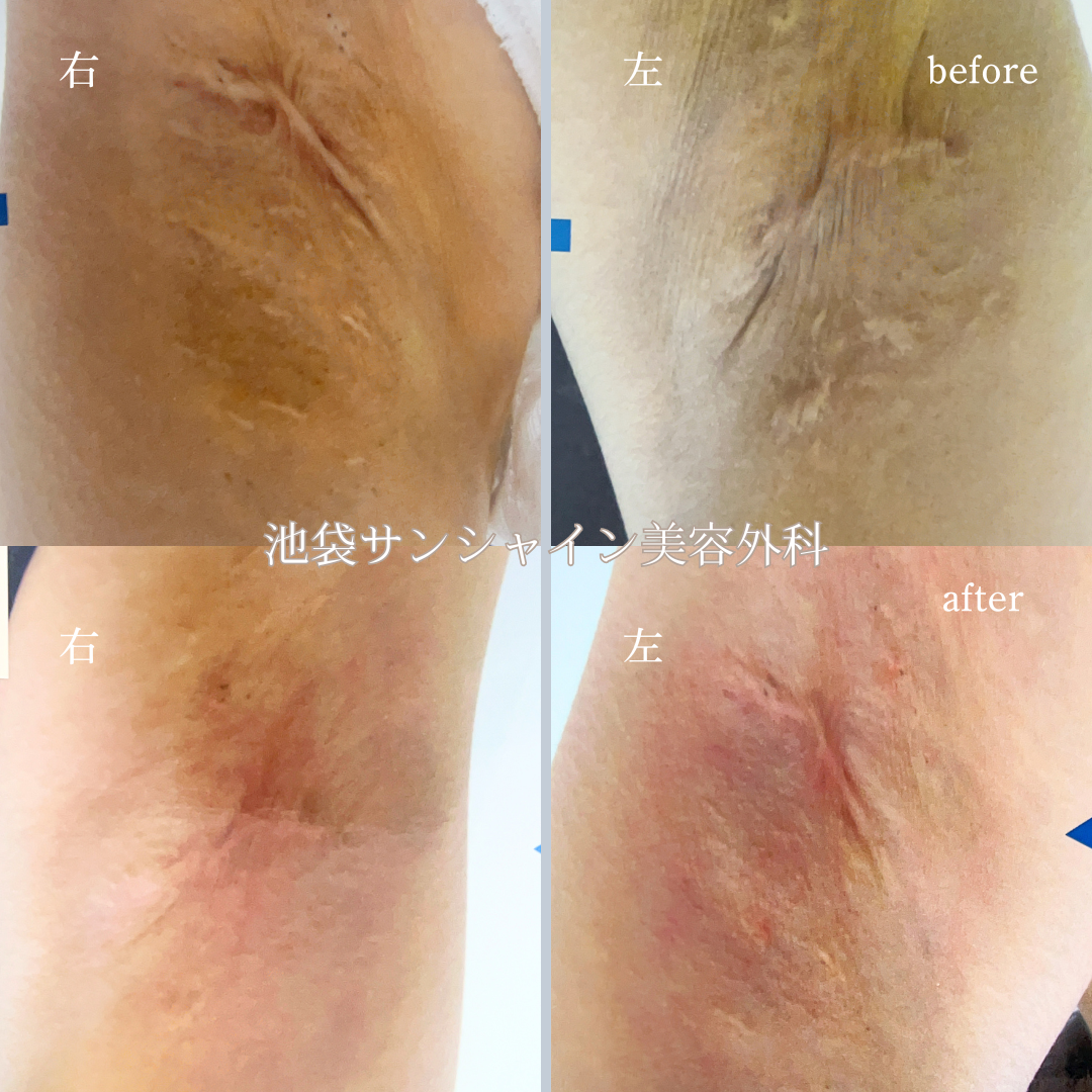 わき施術傷跡修正 左右 before after