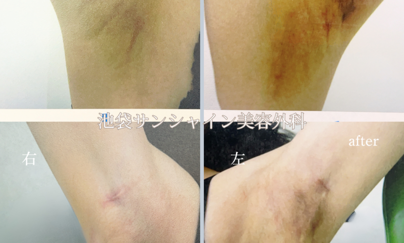 わき施術傷跡修正 左右 before after