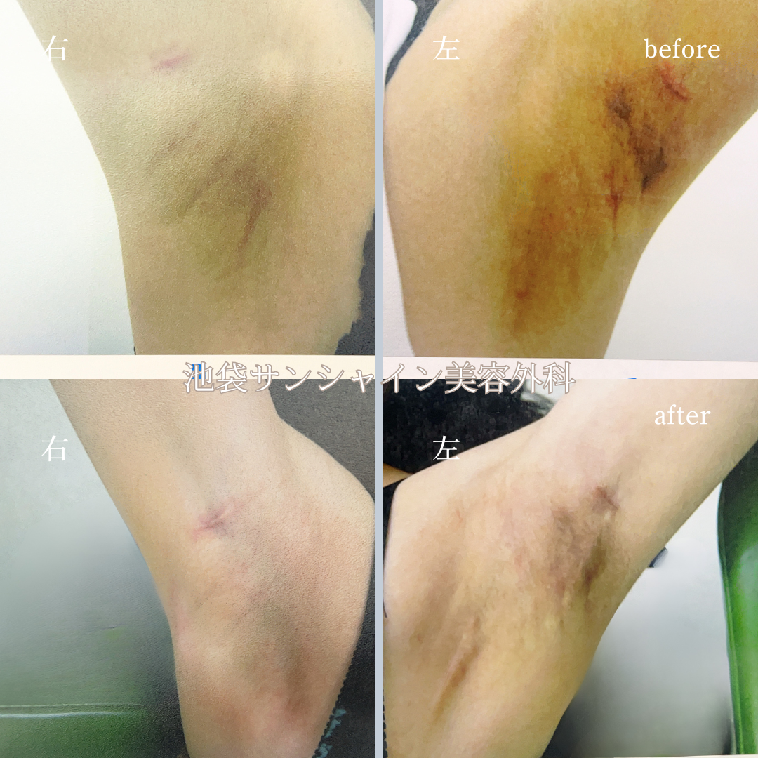 わき施術傷跡修正 左右 before after