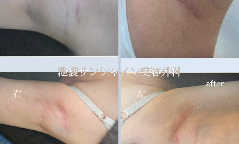 わき施術傷跡修正 左右 before after