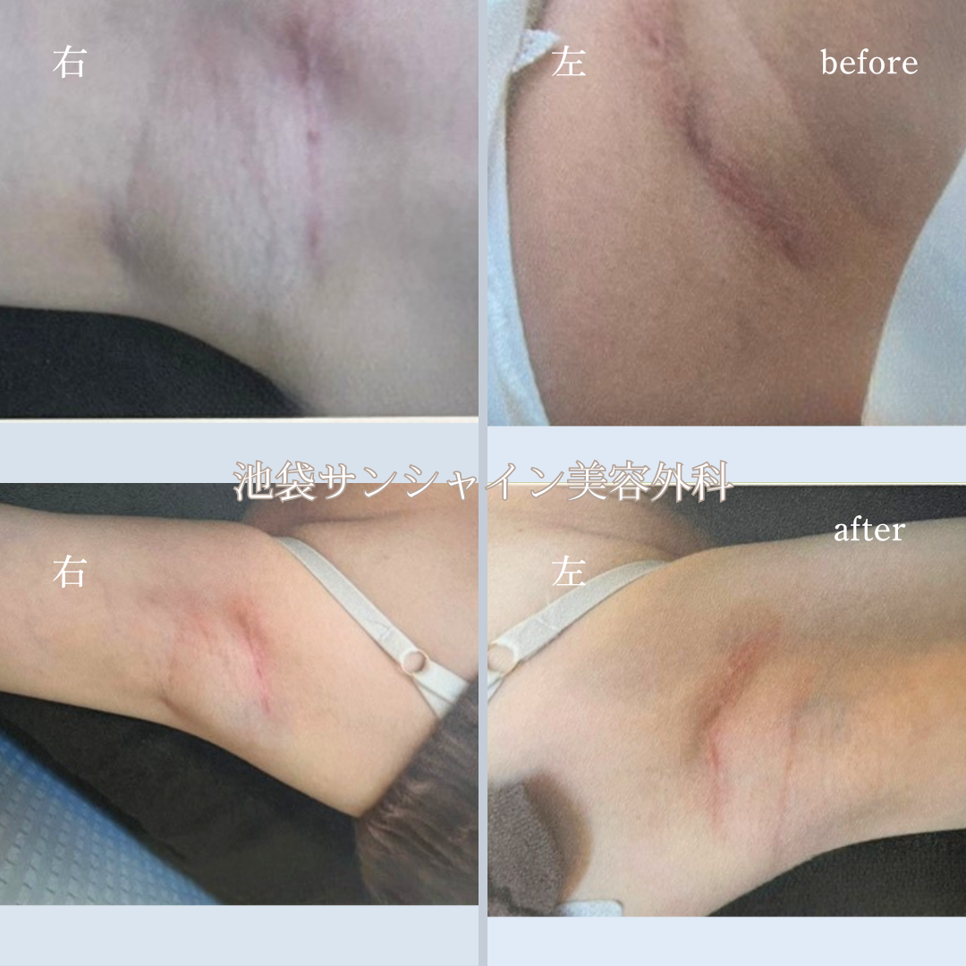わき施術傷跡修正 左右 before after