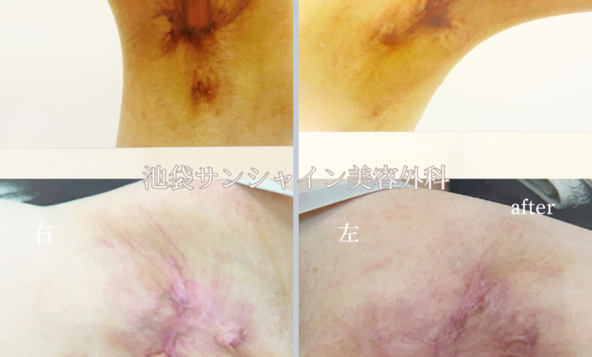 わき施術傷跡修正 左右 before after