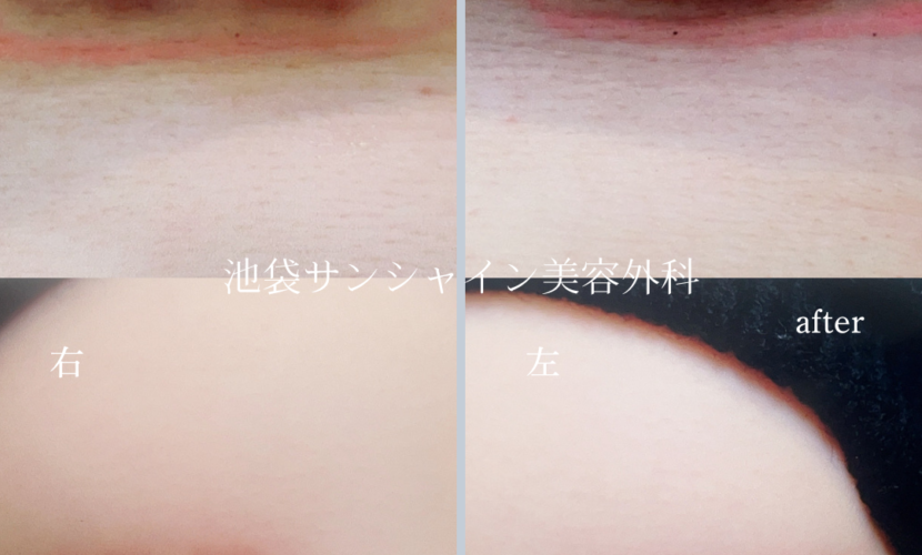豊胸施術傷跡修正 左右 before after