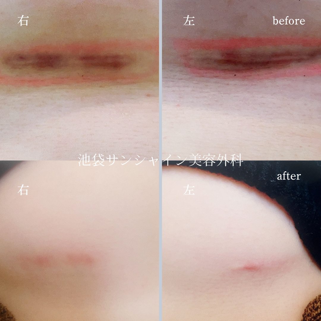 豊胸施術傷跡修正 左右 before after
