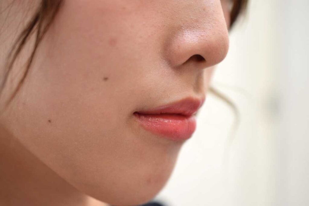 顔にほくろが多い原因とは?病気の可能性や増える理由・除去方法まで医師が解説 5 顔のほくろ除去の選び方