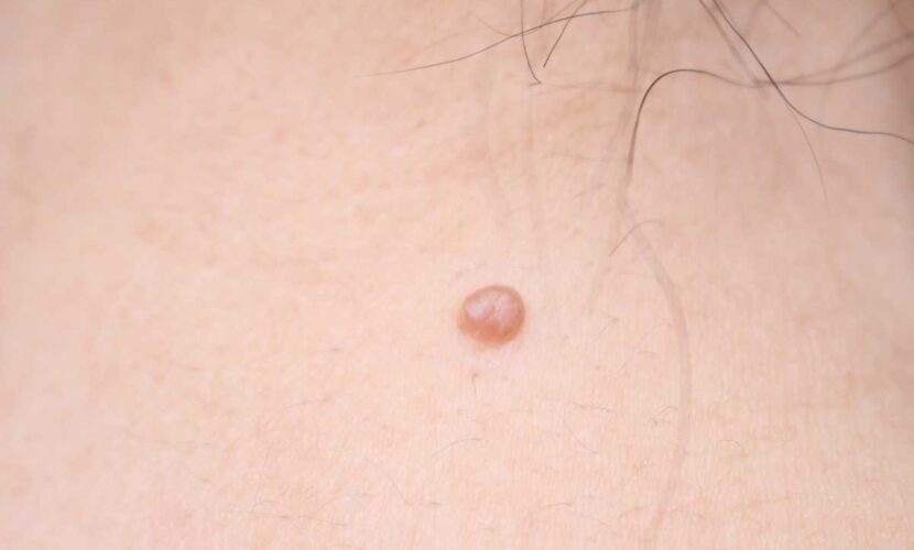 ほくろを目立たなくする隠し方
