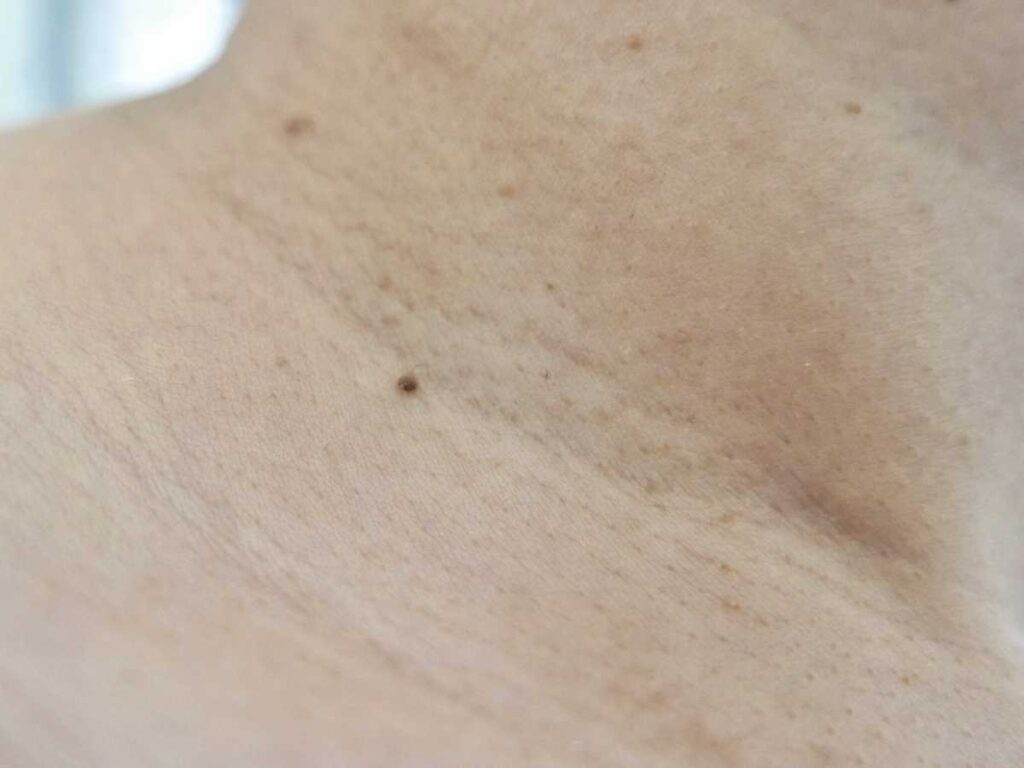 イボの取り方まとめ!自分で取れる?市販薬・民間療法の限界や皮膚科での治療法・費用まで解説 5 イボができたときのケア方法