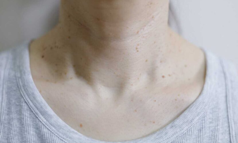 皮膚科で受けられるイボの治療方法