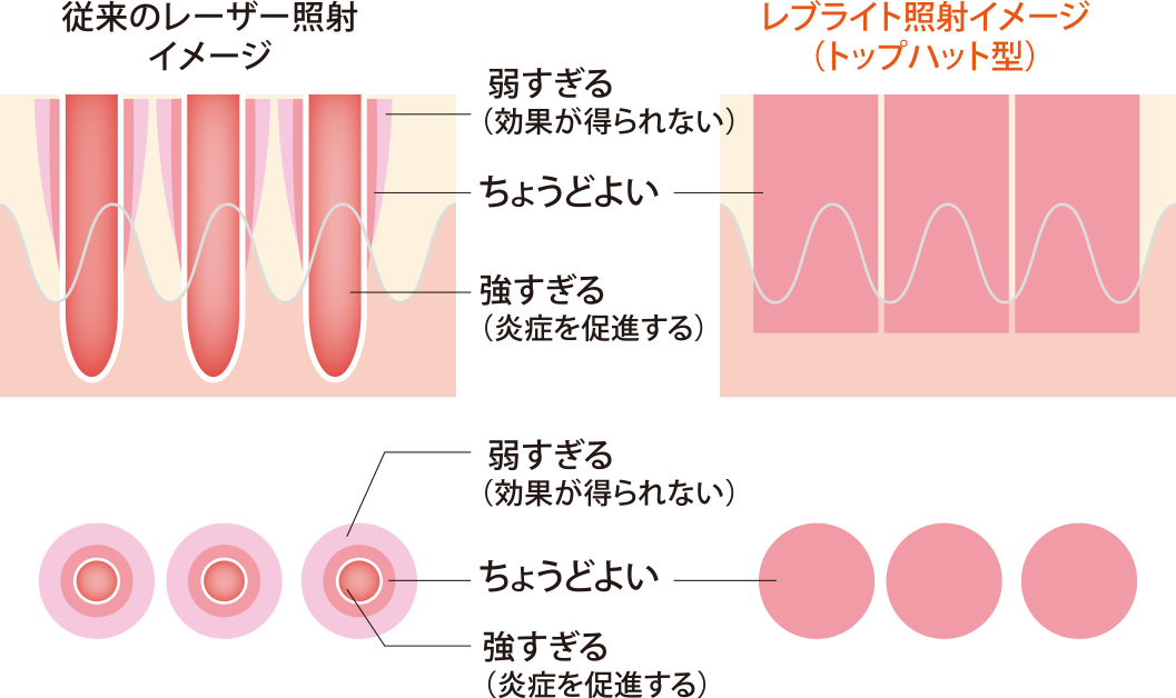 レブライトレーザーの特徴