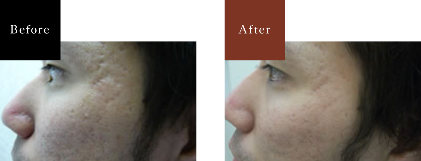 男性 両頬とこめかみの治療