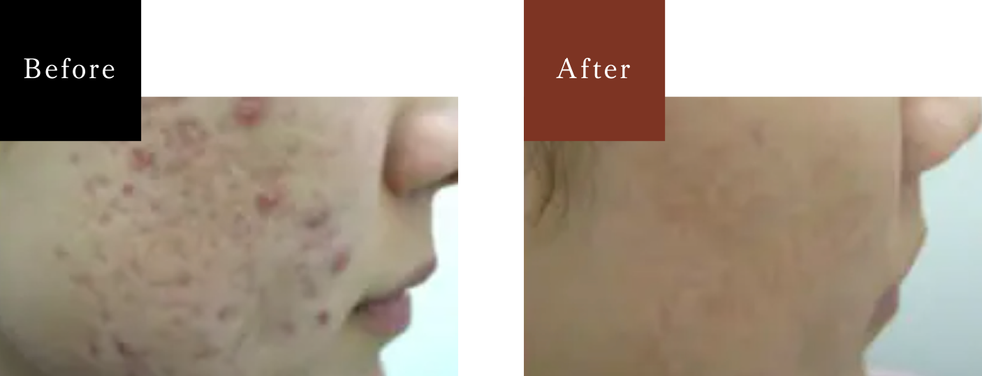 女性 両頬の治療