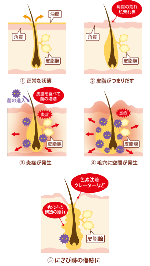 にきびが治らない原因やニキビ跡が傷として残ってしまう理由