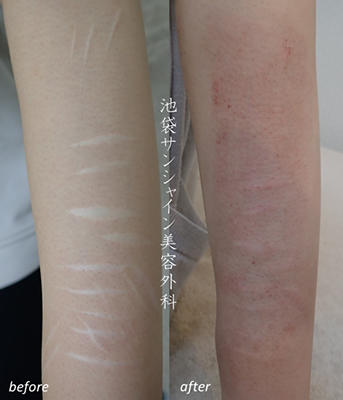 左前腕の傷跡修正を行った症例写真(ビフォーアフター)