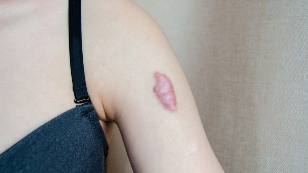 腕にできたケロイドの症例画像